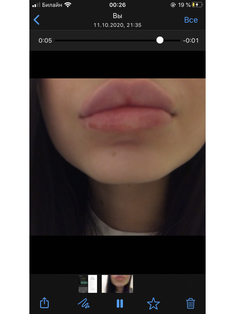 Фото 1. Что делать, если образовался пузырь на губе?