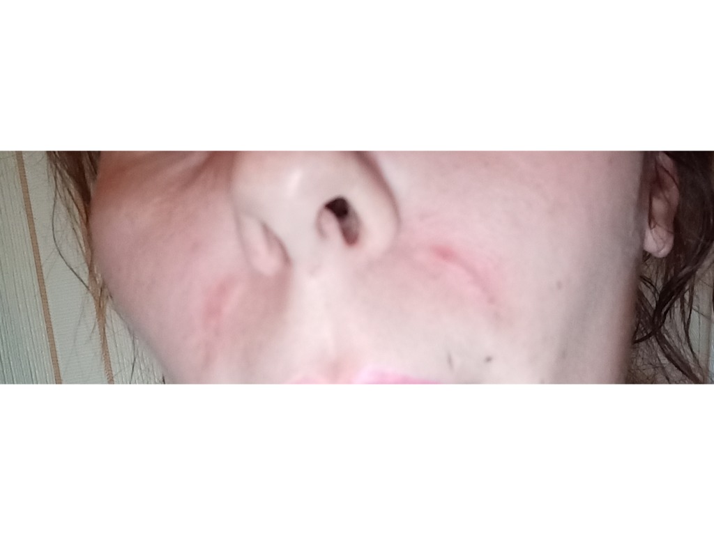 Фото 1. Должно ли так быть после процедуры?