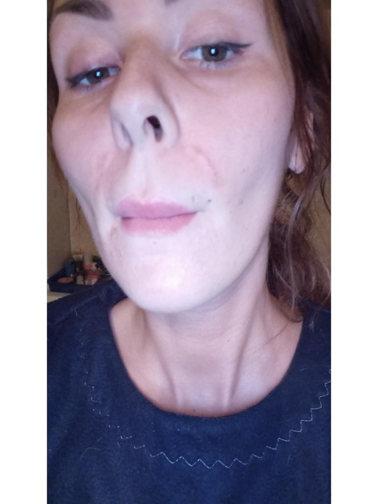 Фото 4. Должно ли так быть после процедуры?