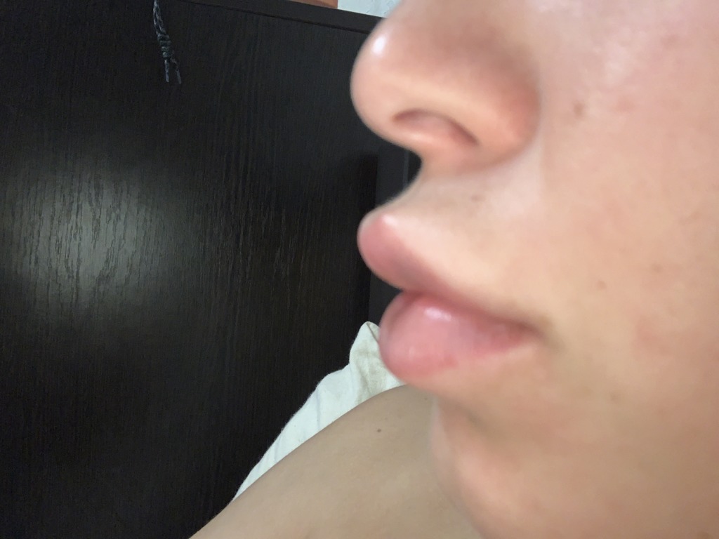 Фото 2. Можно ли гиалуронидазой убрать лишь валик над губой, а не рассасывать весь филлер?