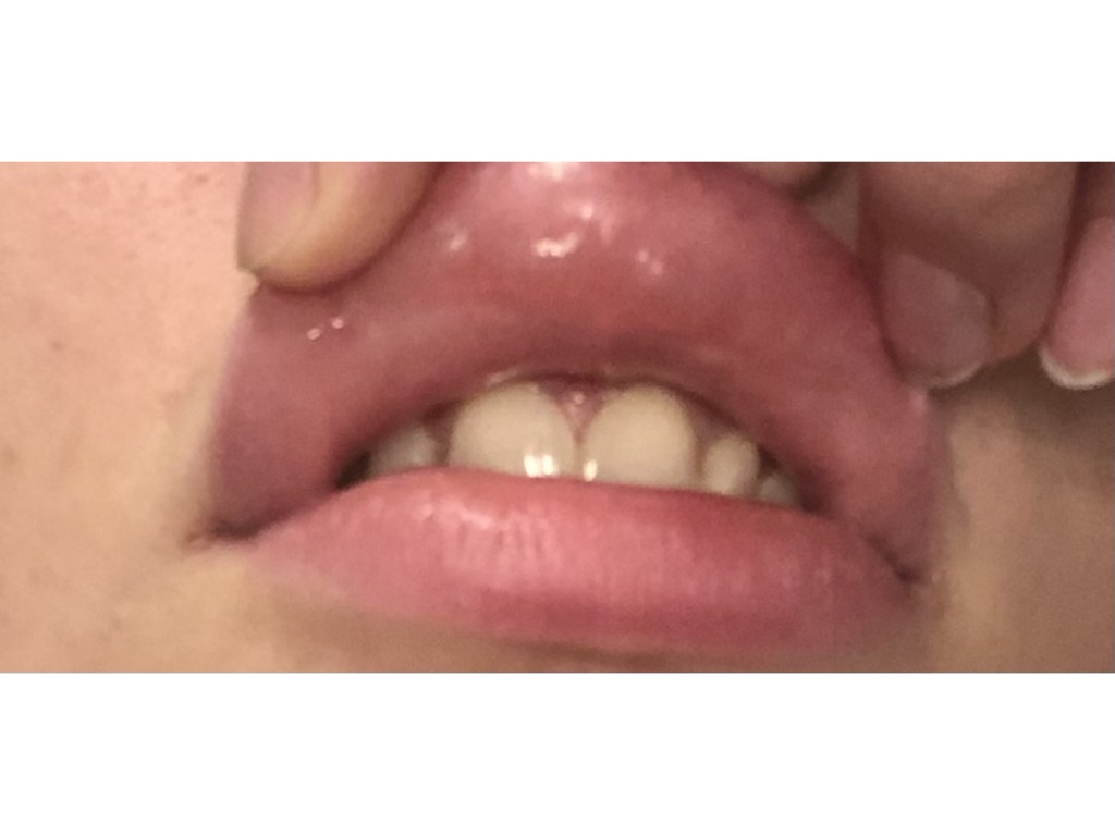 Полезная информация про увеличение губ