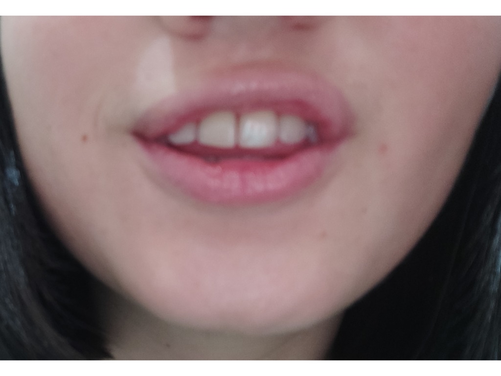 Фото 1. Связана ли ямка на нижней губе с операцией и как это исправить?