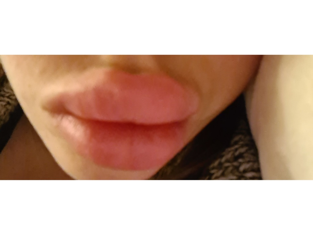 Фото 1. Как часто можно рассасывать гиалуроновую кислоту в губах?