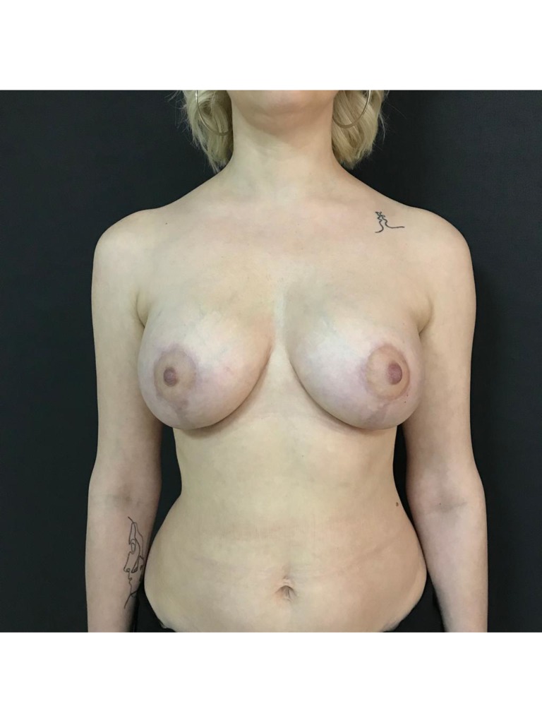 Фото 2. Почему опустилась грудь после установки импланта? И можно ли что-то сделать?