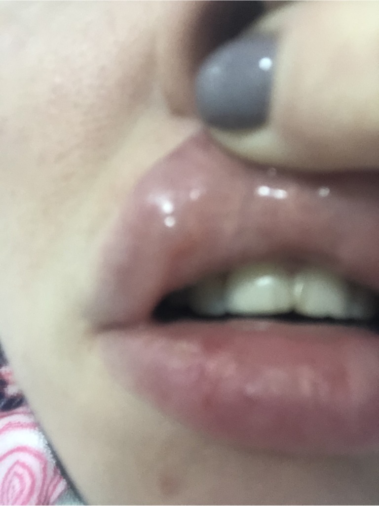 Прозрачные шарики в губах спустя месяц после филлера