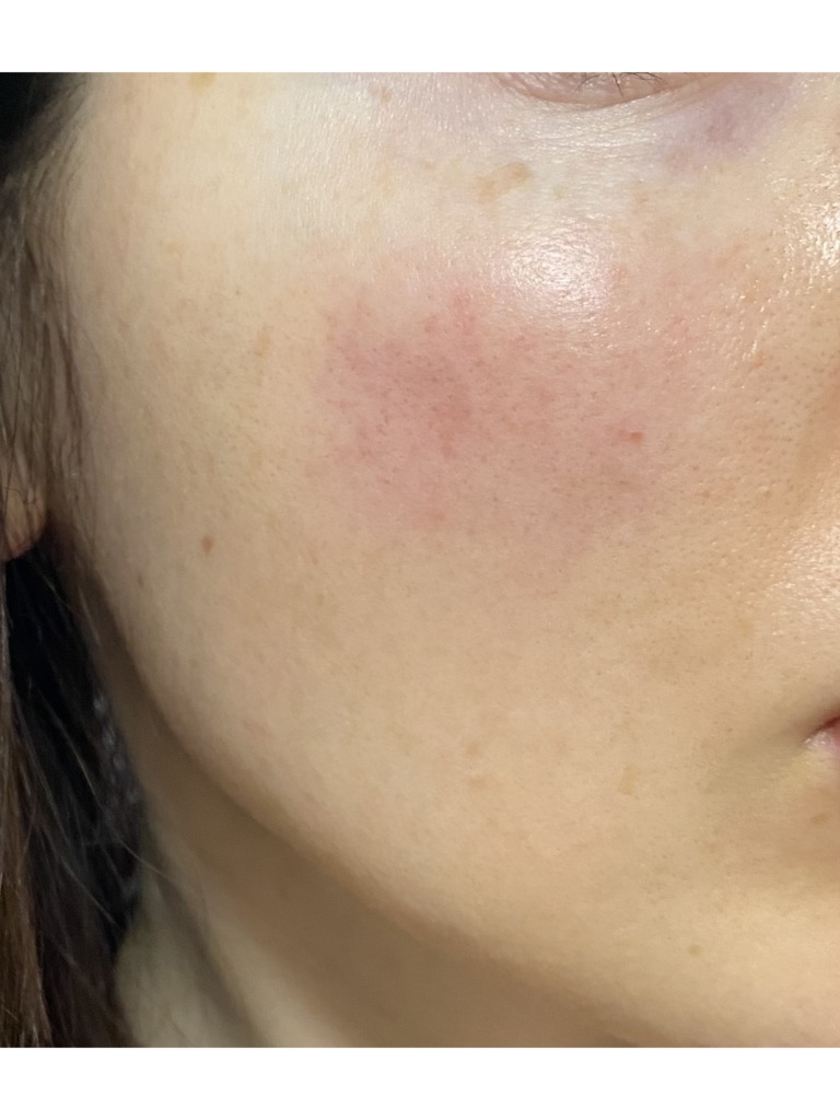 Фото 2. Откуда взялись пятна после филлера?