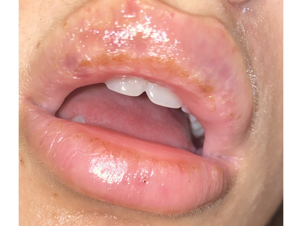 Хейлит – заболевание губ