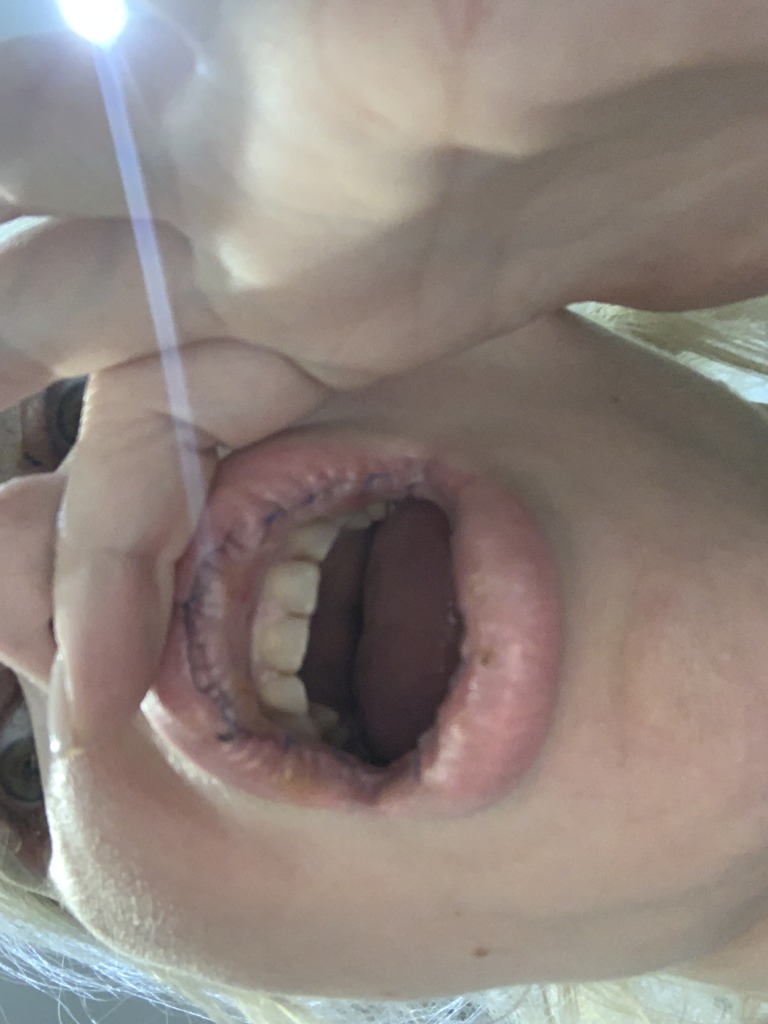 Фото 2. Как ухаживать за швом после удаления полимера из губ?