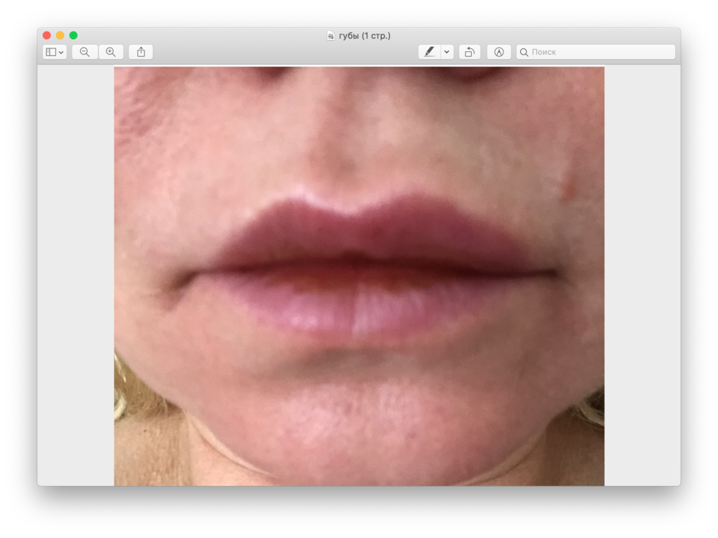 Фото 1. Почему спустя много лет после филлера появляются отеки?