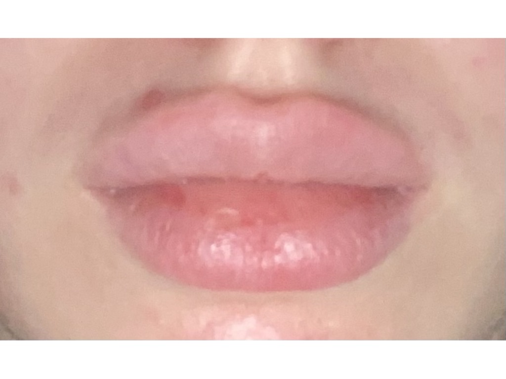 Миграция филлера в губах на слизистой. Через сколько рассосутся губы