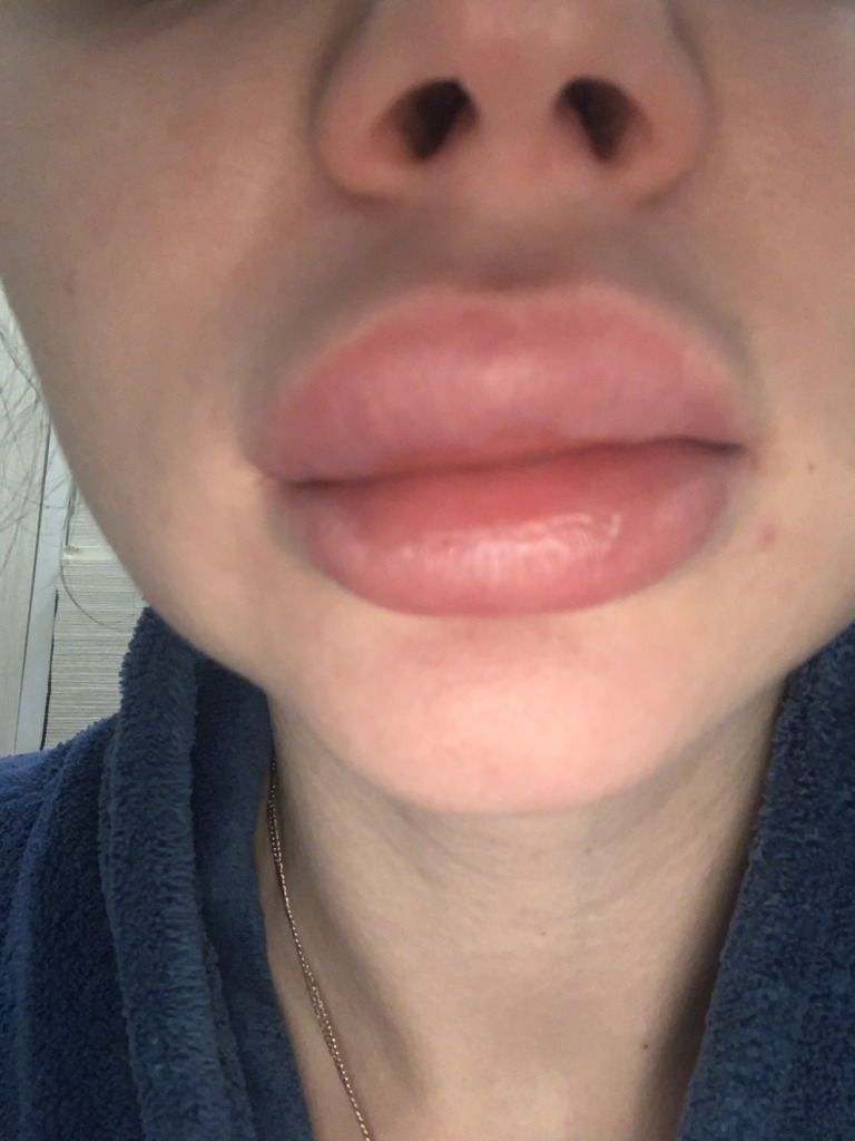 Фото 1. Опухают губы спустя 4 месяца, что это может быть?