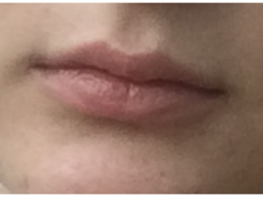 Фото 1. Как исправить неровности губы?