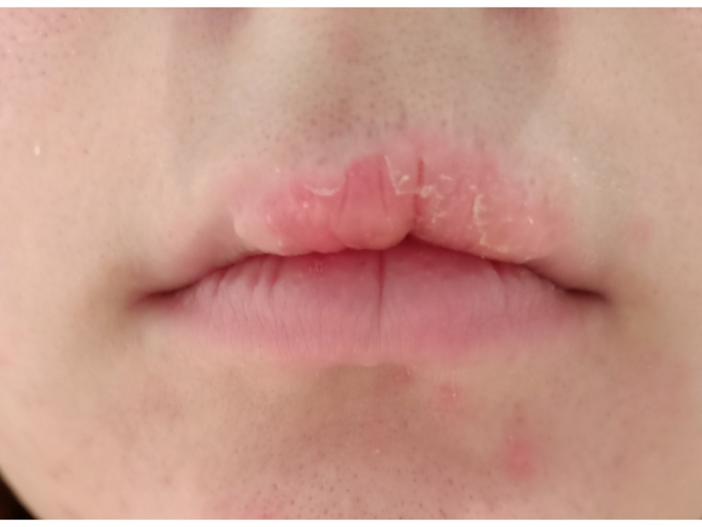 Фото 2. Как исправить неровности губы?
