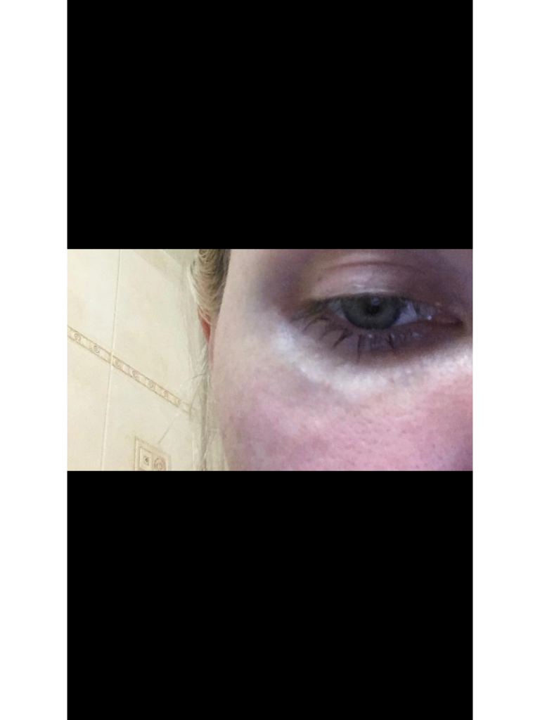 Фото 1. Как быть с вмятиной после липолитика?