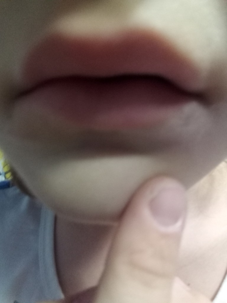 Фото 1. Что может быть с моей губой?