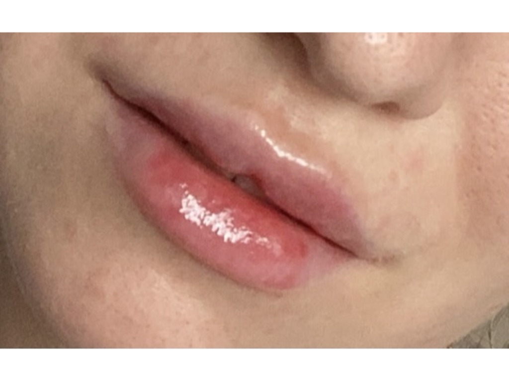 Фото 1. Как снять жжение и покраснение на губе после филлера?