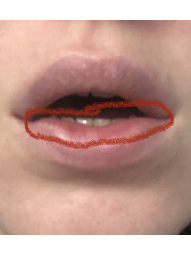 Фото 1. В чем может быть причина уплотнения и ассиметрии спустя столько времени?