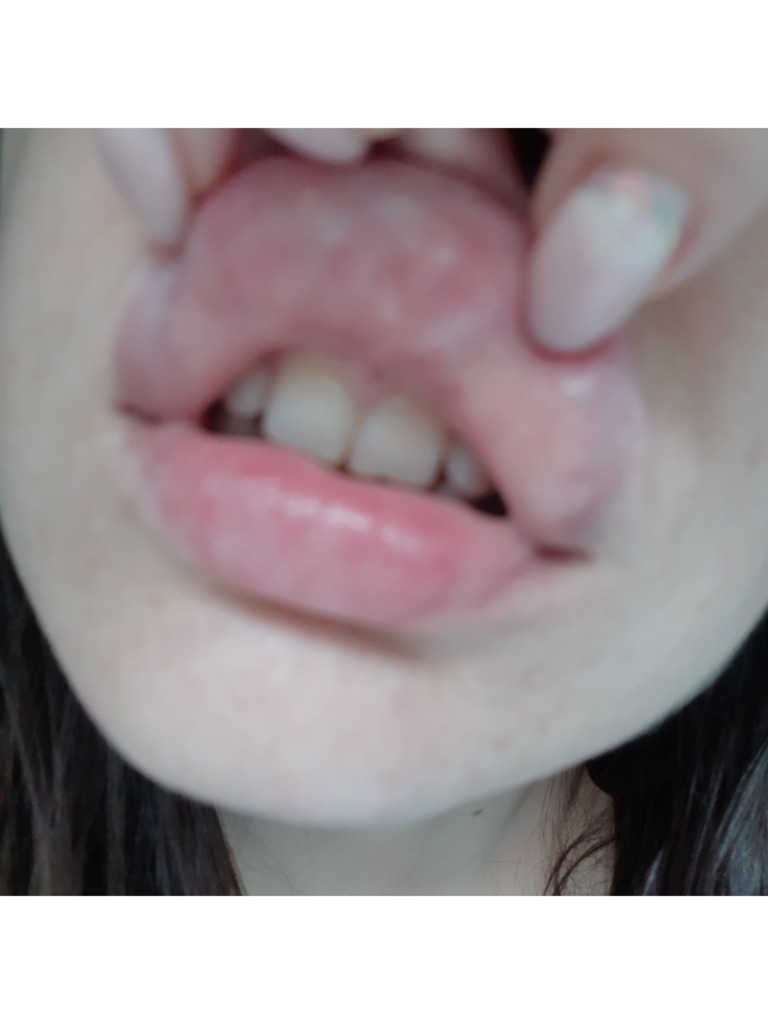 Удаление ретенционной кисты губы