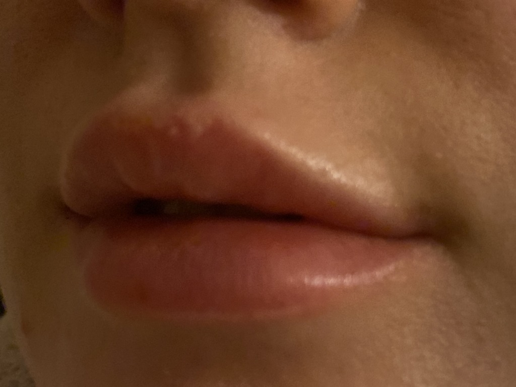 Фото 3. Шарики в губе это фиброз?