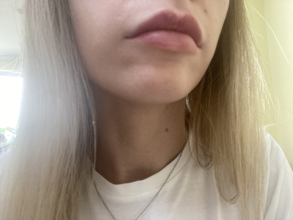 Фото 2. Может ли мигрировать гиалуронка?