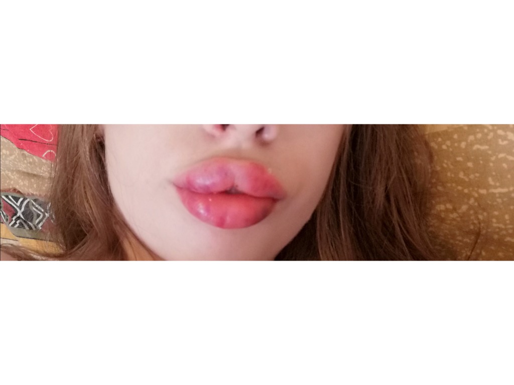 Когда можно целоваться после губ. Появилась щель между губами. Щель между верхними губами.