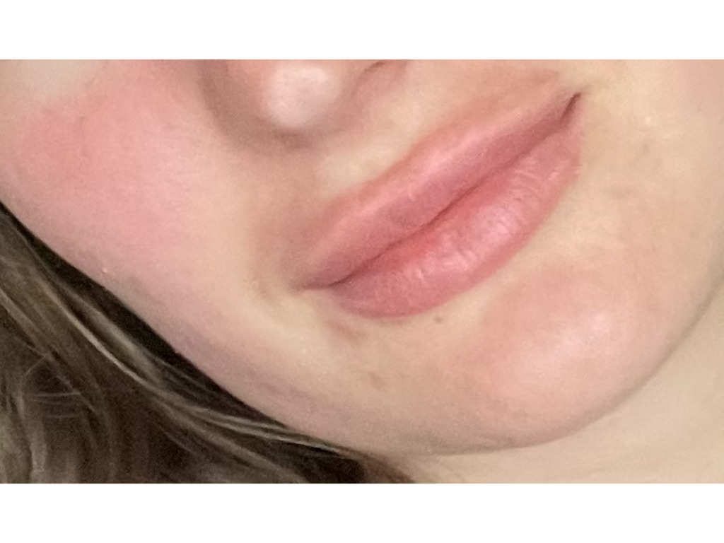 Увеличение губ усы гиалуроновые. Гель над верхней губой. Усы после увеличения губ.
