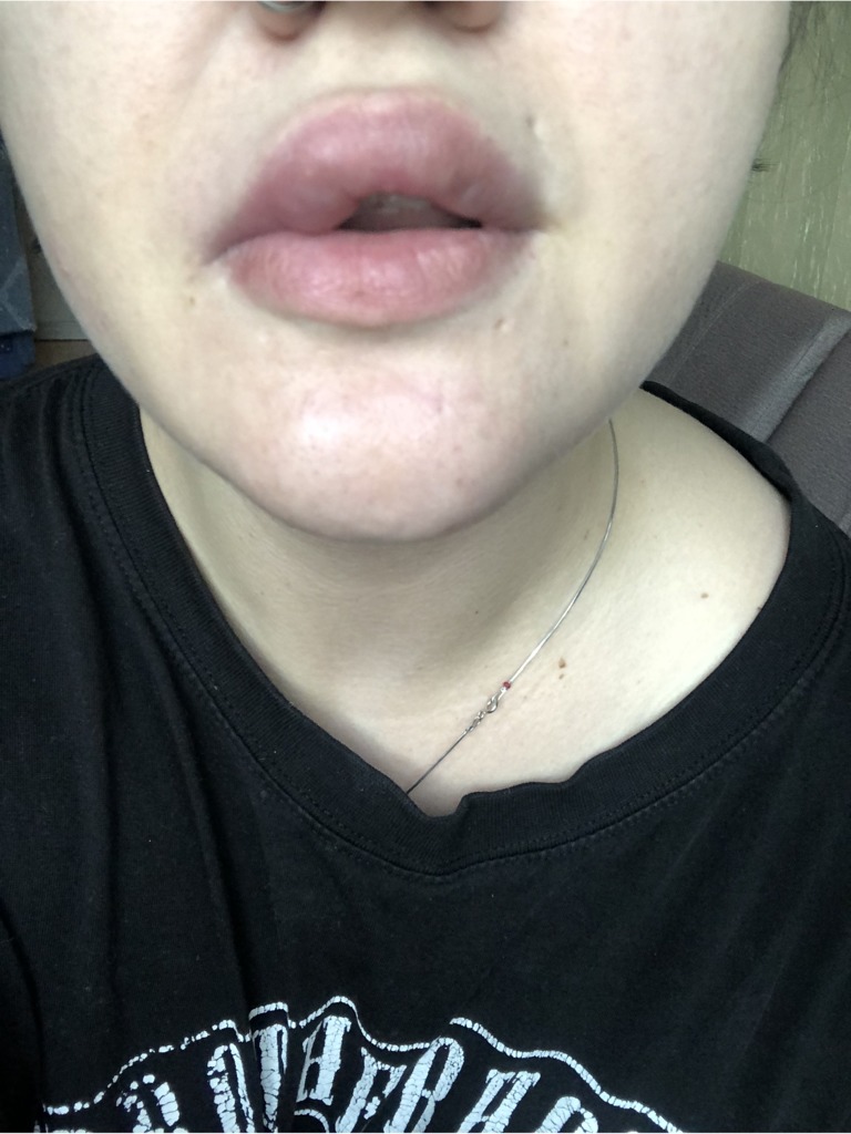 Фото 1. Болит отек после увеличения губ