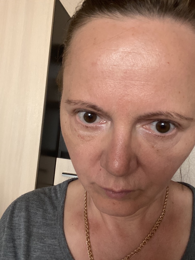 Фото 2. Как убрать грыжы на нижних веках?