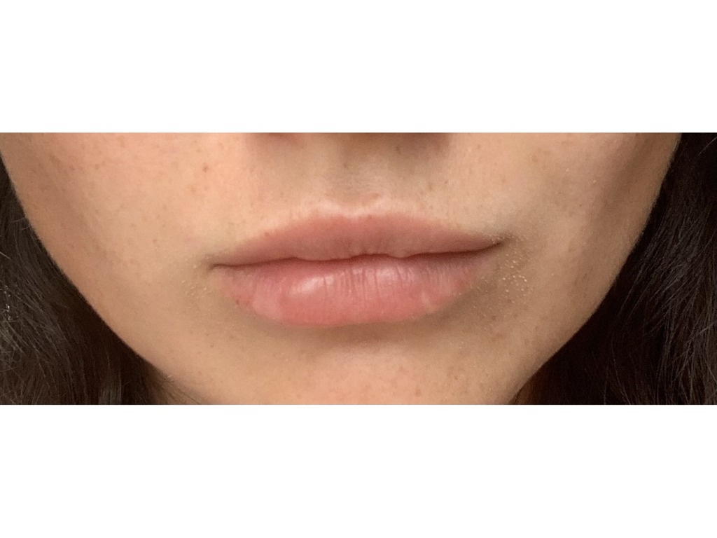 Фото 4. Как убрать комочек после филлера?