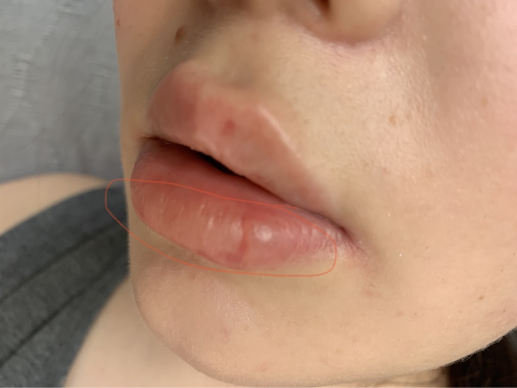 Фото 2. Опасно ли появление белых пузырьков после контурной пластики губ?