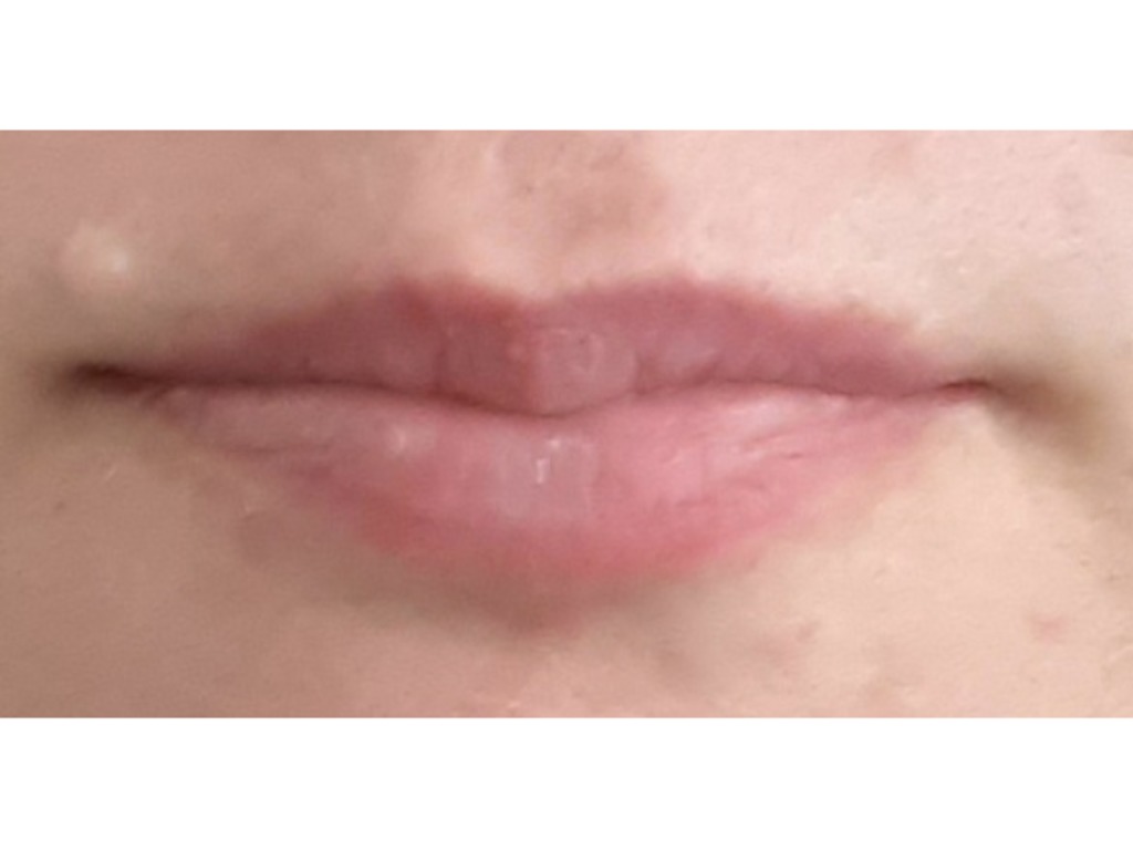 Увеличение губ усы гиалуроновые. Усы над верхней губой после увеличения. Усы от гиалуроновой кислоты. Гиалуроновые усы над верхней губой.