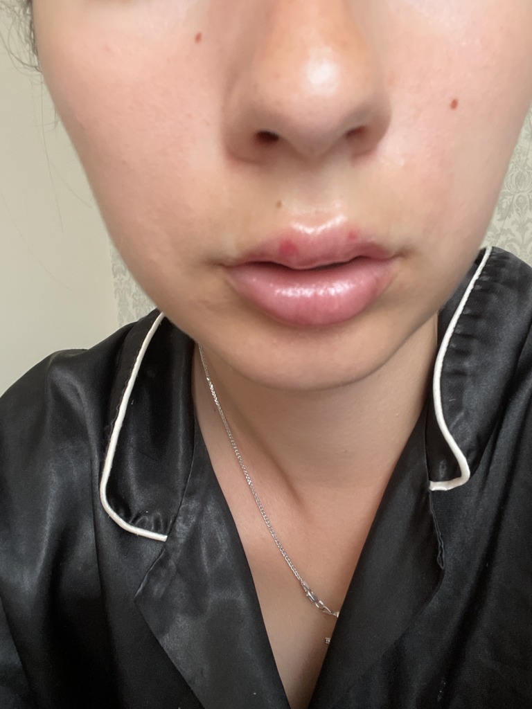 Ассиметрия губы после Стилейдж М