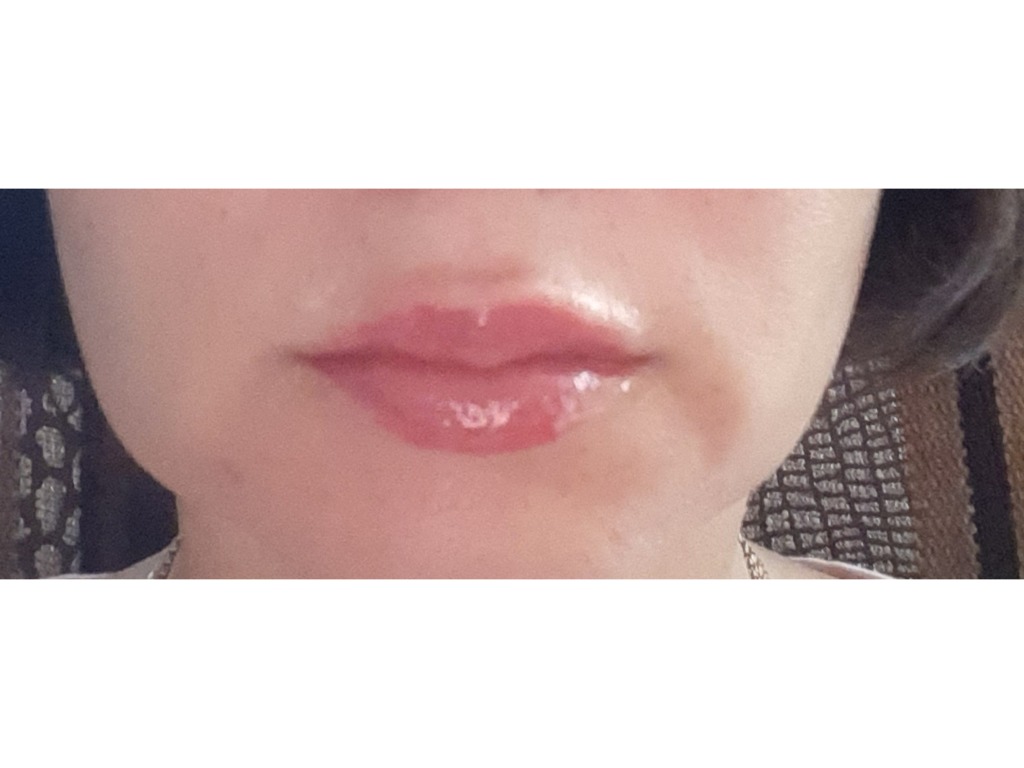 Увеличение губ усы гиалуроновые. Усы после увеличения губ фото. Гиалуроновые усы над губой. Гиалуроновые усы после увеличение губ.