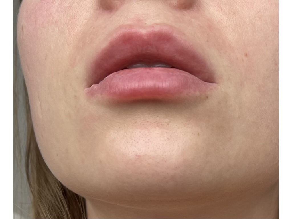 Красная точка на губе внутри - Вопрос стоматологу - 03 Онлайн