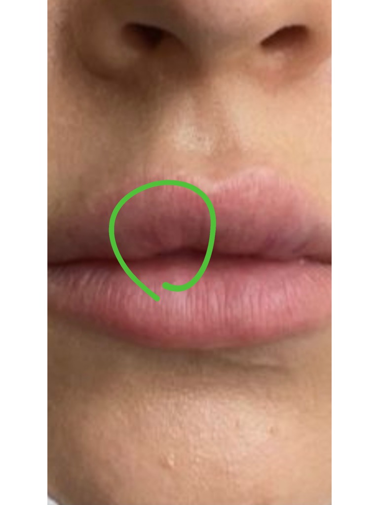 Фото 3. Как решить проблему вмятины на губе после филлера?