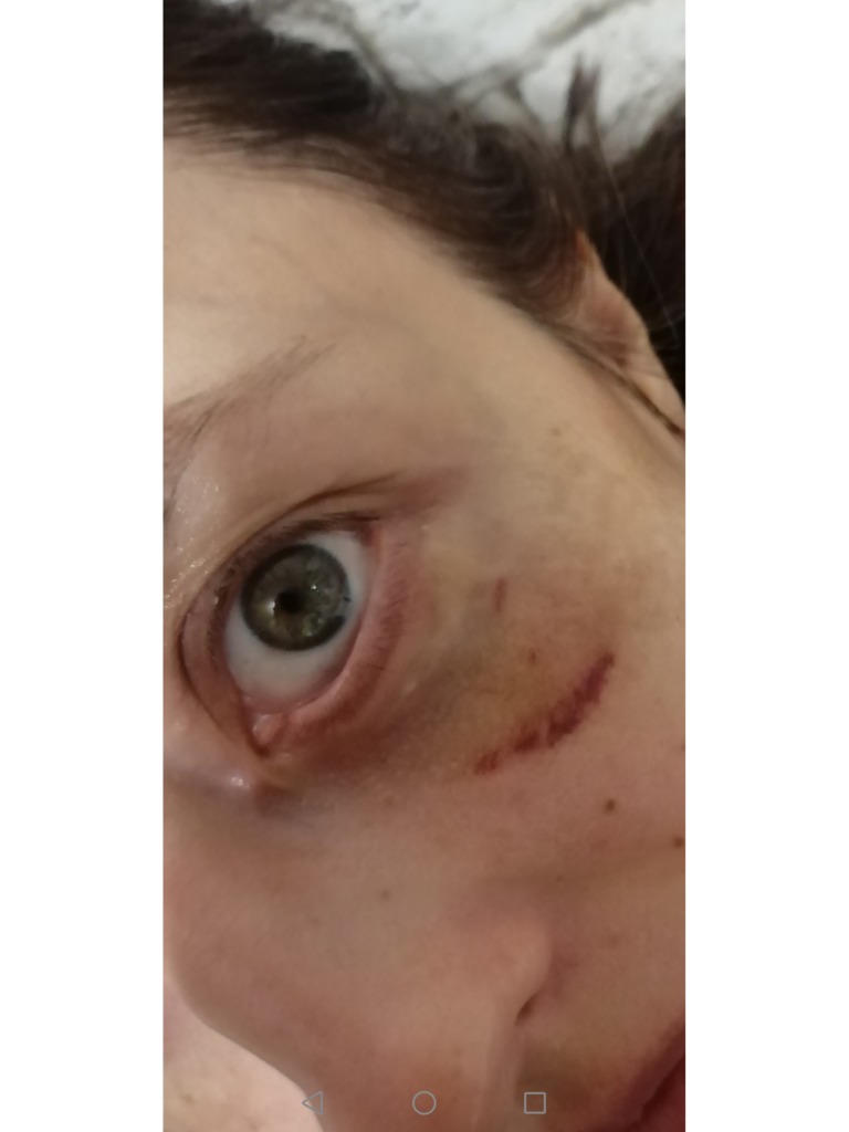 Фото 1. Что делать, чтобы веко начало смыкаться?