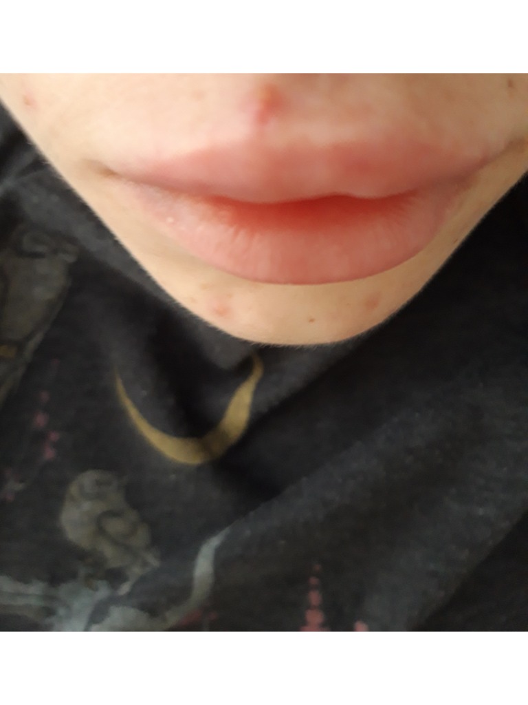 Фото 3. Можно ли ассиметрию в губах  после филлера исправить массажем?