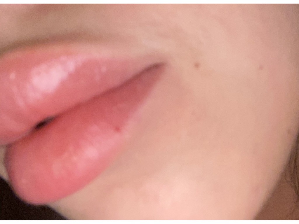 Фото 1. Может ли быть пятно связано с увеличением губ?