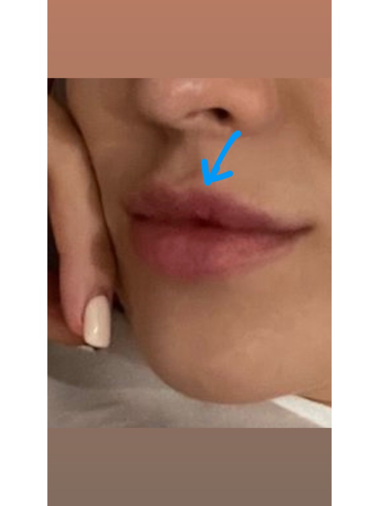 Фото 1. Как решить проблему вмятины на губе после филлера?
