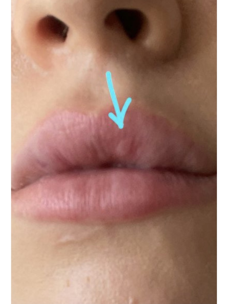 Фото 2. Как решить проблему вмятины на губе после филлера?