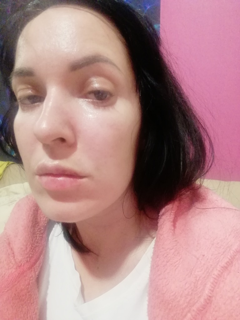 Фото 1. Очень переживаю, нормальна ли такая реакция на филлер?