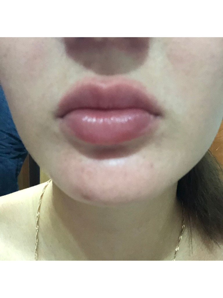 Фото 1. Почему покраснение на губе после увеличения спустя месяц?