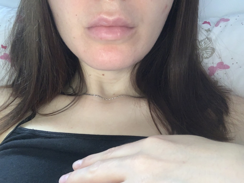 Фото 3. Можно ли исправить ситуацию массажем, или придётся удалять филлер Лидазой?