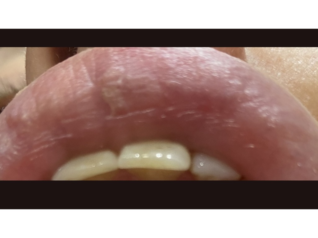 Фото 2. Такие ощущения от увеличения губ нормальны?