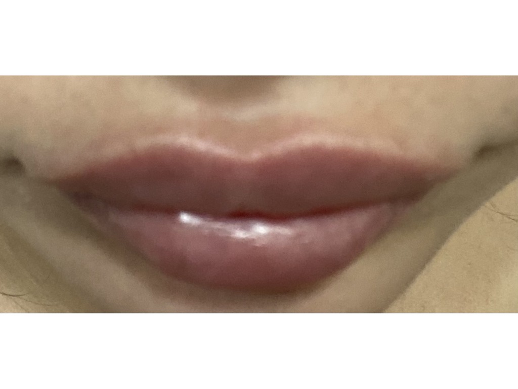 Увеличение губ усы гиалуроновые. Усы от гиалуроновой кислоты. Лонгидаза над верхней губой. Гиалуроновые усы над губой. Фото гиалуроновых усов.
