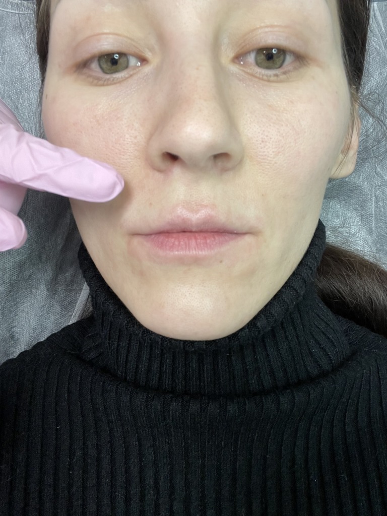 Фото 1. Почему появился такой «клюв» после коррекции Ювиермом?