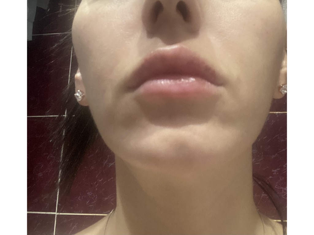 Фото 3. Уйдет ли ассиметрия вместе с отеком?