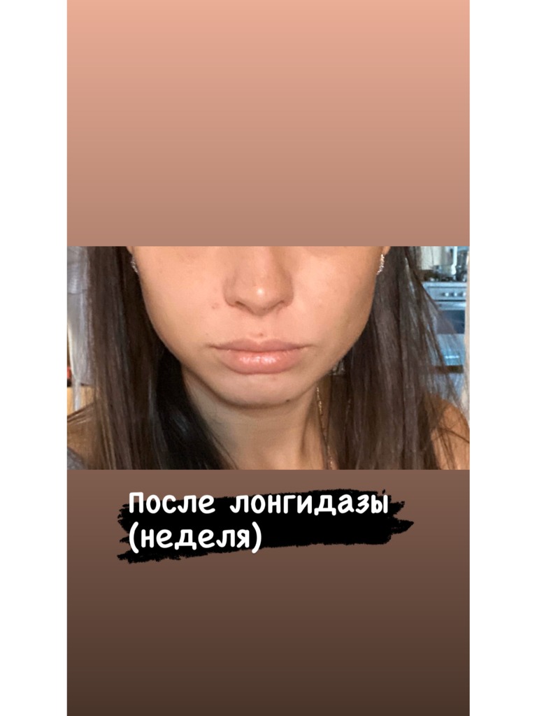 Фото 2. Что делать, если раздувает губы?