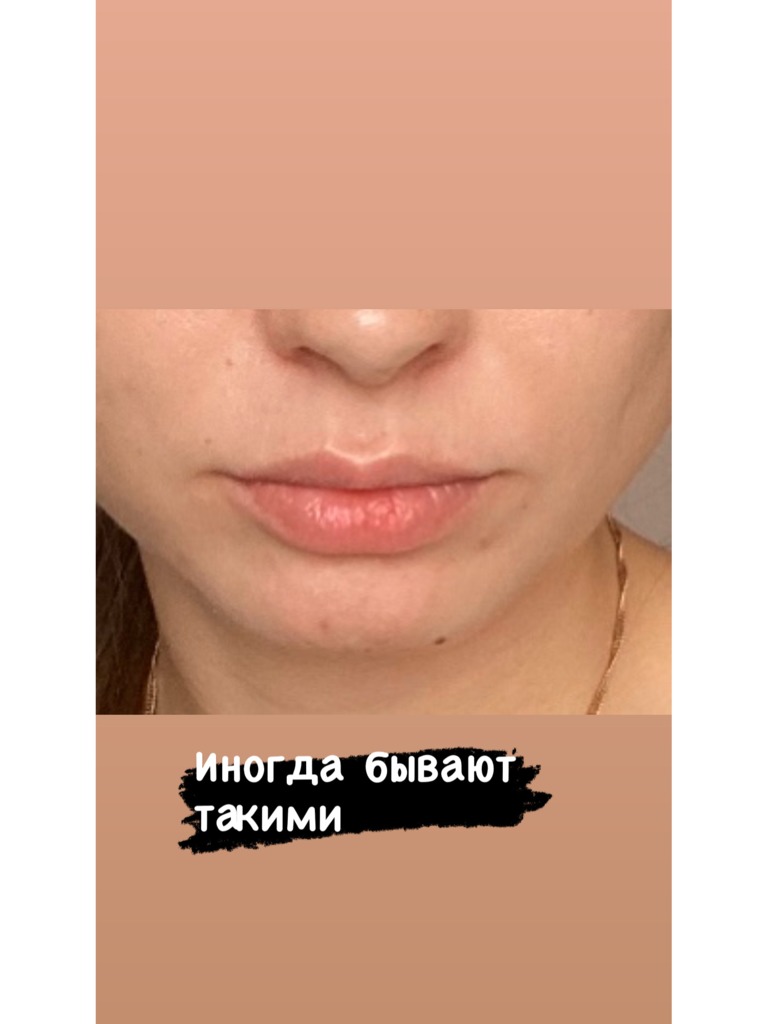 Фото 3. Что делать, если раздувает губы?