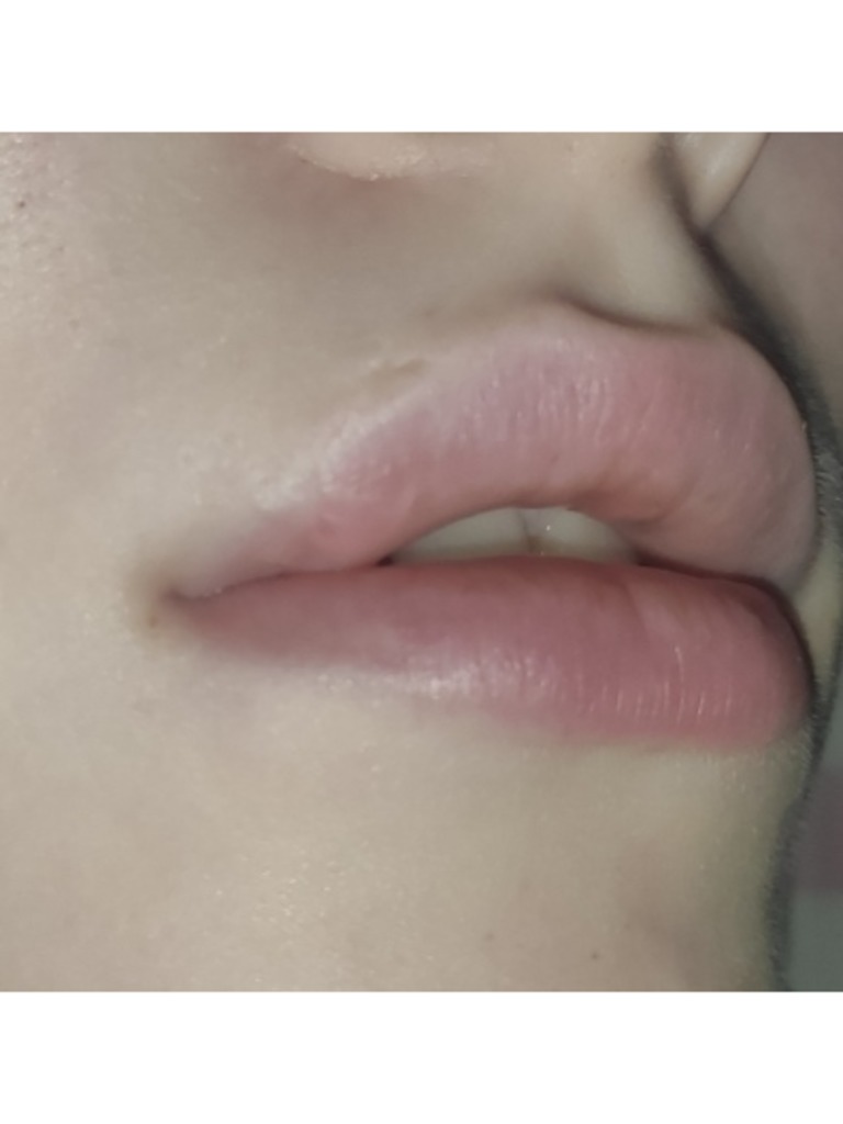 Фото 3. Как убрать рубец?